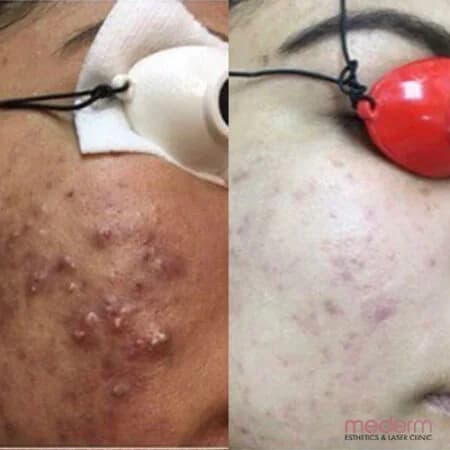 Acne: before and after treatment comparison 1