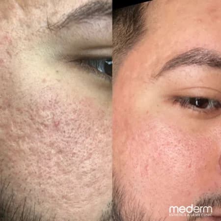 Acne scars: before and after treatment comparison 1
