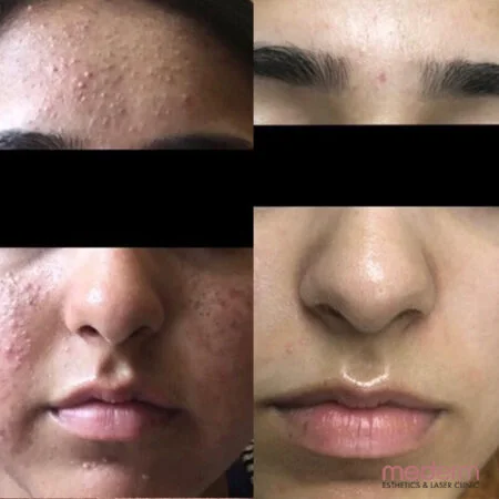 Acne: before and after treatment comparison 2
