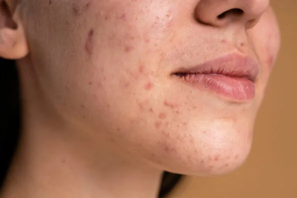 Acne care treatment illustration