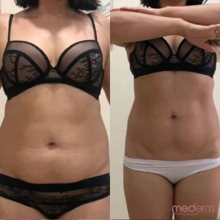 Body Contouring: before and after treatment comparison 1