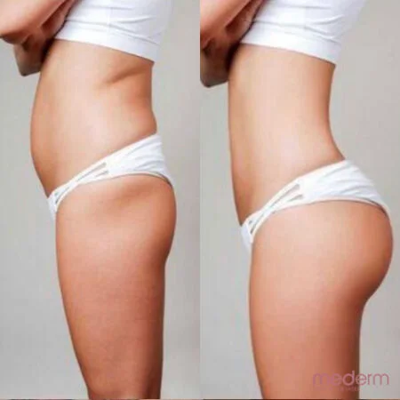 Body Contouring: before and after treatment comparison 3