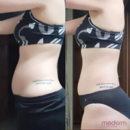 Body Contouring: before and after treatment comparison 2