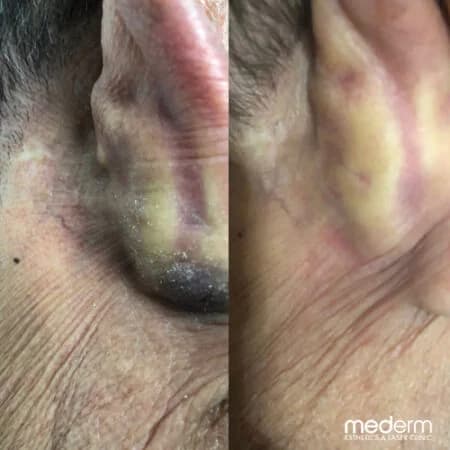 Skin tags & electrocautery: before and after treatment comparison 3