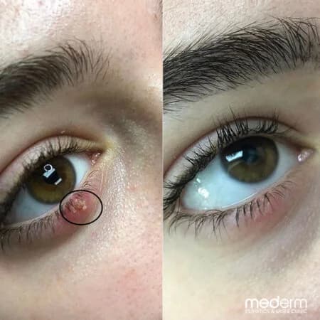 Skin tags & electrocautery: before and after treatment comparison 12