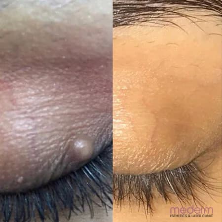 Skin tags & electrocautery: before and after treatment comparison 14
