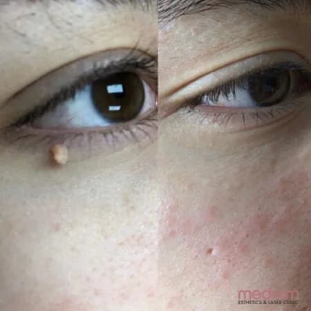 Skin tags & electrocautery: before and after treatment comparison 15
