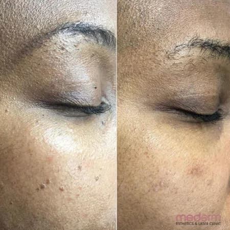 Skin tags & electrocautery: before and after treatment comparison 16