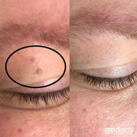 Skin tags & electrocautery: before and after treatment comparison 6