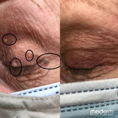 Skin tags & electrocautery: before and after treatment comparison 8