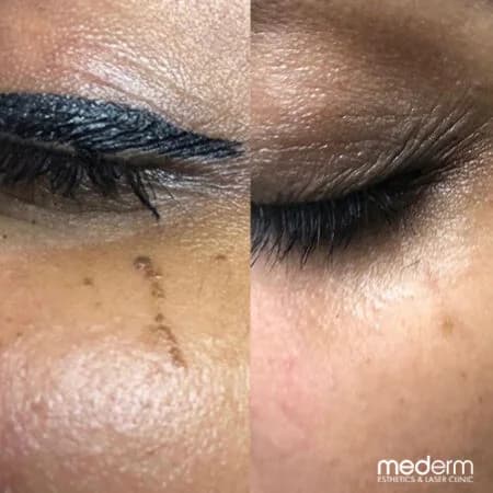 Skin tags & electrocautery: before and after treatment comparison 9