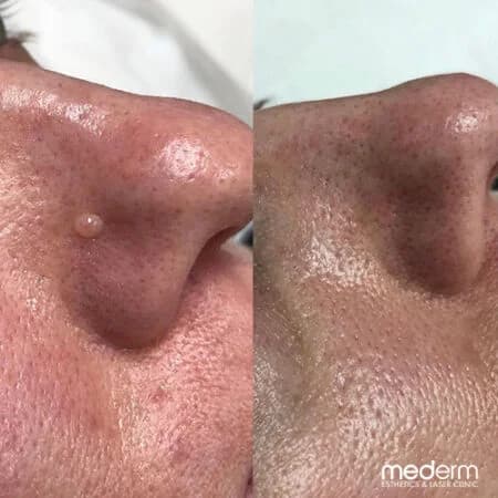 Skin tags & electrocautery: before and after treatment comparison 11