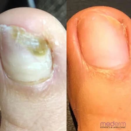 Nail Fungus: before and after treatment comparison 2