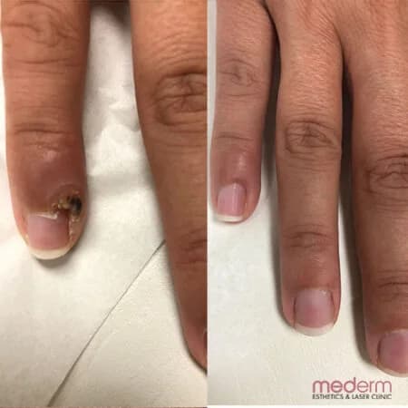 Warts: before and after treatment comparison 2