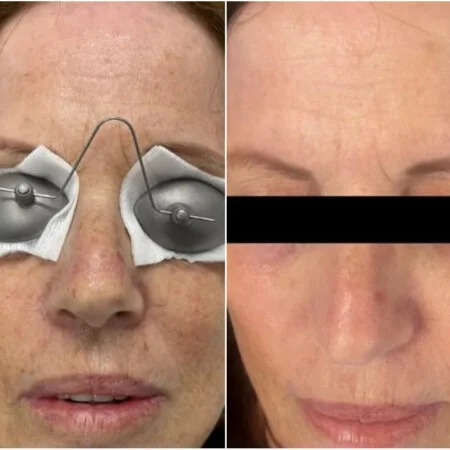 Photo Facial: before and after treatment comparison 1
