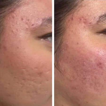 Scar Treatment: before and after treatment comparison 1