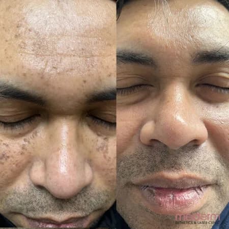 Skin tags & electrocautery: before and after treatment comparison 21
