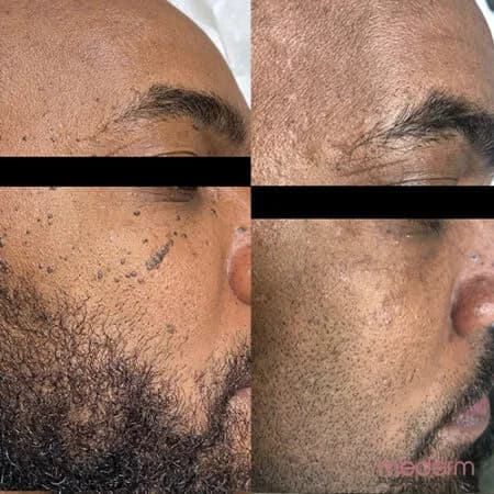 Skin tags & electrocautery: before and after treatment comparison 19