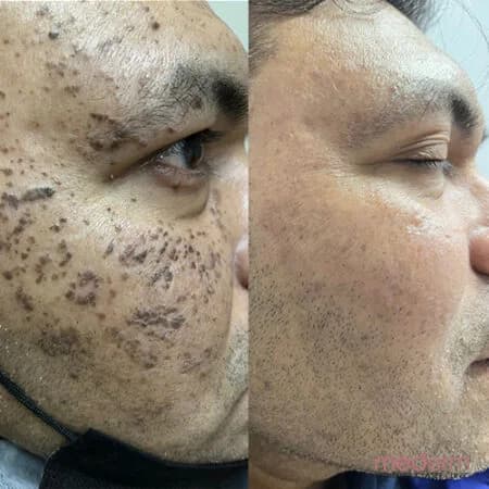 Skin tags & electrocautery: before and after treatment comparison 17