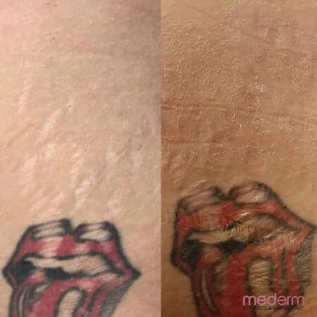 Stretch Marks: before and after treatment comparison 1