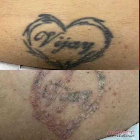 Tattoo Removal: before and after treatment comparison 1