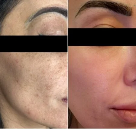 Melasma & Hyperpigmentation: before and after treatment comparison 1