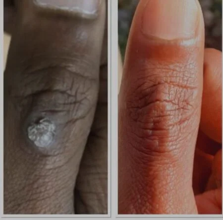 Warts: before and after treatment comparison 1